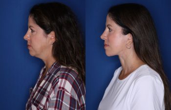 48 year old female 1 year post op from Kaloslift extended deep plane facelift with platysmaplasty neck lift and fat transposition lower eyelid blepharoplasty