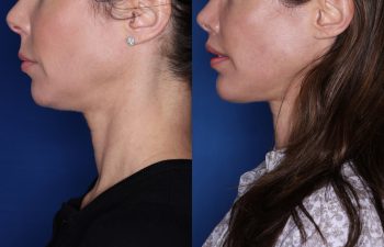 47 year old female patient 3 months post op from a Rhinoplasty, Chin Implant, and Perialar Lip Lift.