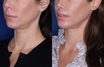 47 year old female patient 3 months post op from a Rhinoplasty, Chin Implant, and Perialar Lip Lift.