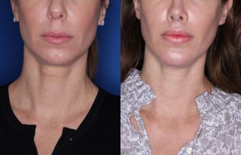 47 year old female patient 3 months post op from a Rhinoplasty, Chin Implant, and Perialar Lip Lift.