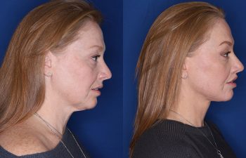 55 year old female patient 2 years post op from her KalosLift (Mini Extended Deep Plane Facelift/Neck Lift), Platysmaplasty, Blepharoplasty, and Perialar Lip Lift.