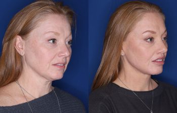 55 year old female patient 2 years post op from her KalosLift (Mini Extended Deep Plane Facelift/Neck Lift), Platysmaplasty, Blepharoplasty, and Perialar Lip Lift.