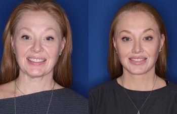 55 year old female patient 2 years post op from her KalosLift (Mini Extended Deep Plane Facelift/Neck Lift), Platysmaplasty, Blepharoplasty, and Perialar Lip Lift.