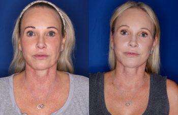 54 year old female 3 months post op from a Revision KalosLift (Mini Extended Deep Plane Facelift) and Platysmaplasty