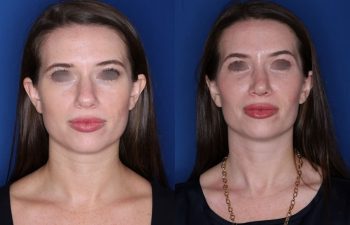 31 year old female patient 1 month post-op from Otoplasty