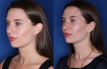 31 year old female patient 1 month post-op from Otoplasty