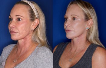 54 year old female 3 months post op from a Revision KalosLift (Mini Extended Deep Plane Facelift) and Platysmaplasty