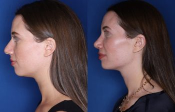 31 year old female patient 1 month post-op from Otoplasty