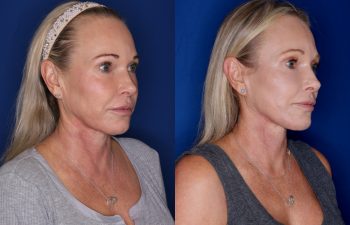 54 year old female 3 months post op from a Revision KalosLift (Mini Extended Deep Plane Facelift) and Platysmaplasty