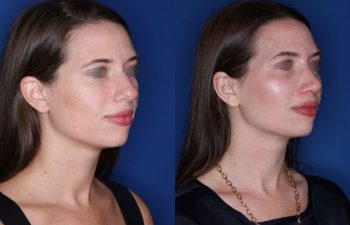 31 year old female patient 1 month post-op from Otoplasty