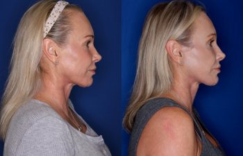 54 year old female 3 months post op from a Revision KalosLift (Mini Extended Deep Plane Facelift) and Platysmaplasty