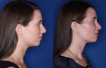 31 year old female patient 1 month post-op from Otoplasty