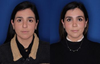 37 year old female patient 10 months post-op from a Rhinoplasty.