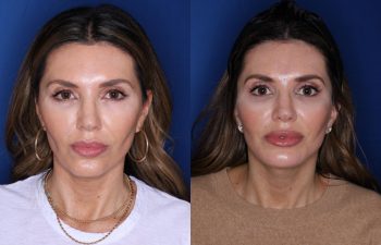 45 year old female patient 2 months post-op from a KalosLift (Mini Extended Deep Plane Facelift) with Platysmaplasty