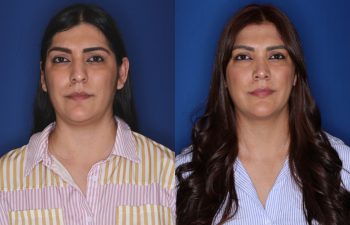 33 year old female patient 9 months post-op from a Rhinoplasty