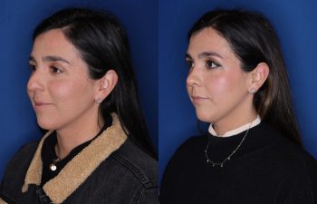 37 year old female patient 10 months post-op from a Rhinoplasty.