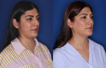 33 year old female patient 9 months post-op from a Rhinoplasty