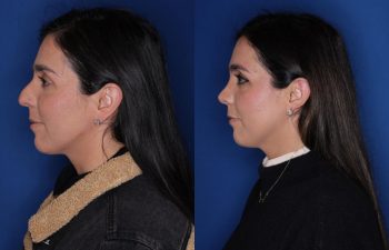 37 year old female patient 10 months post-op from a Rhinoplasty.