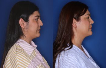 33 year old female patient 9 months post-op from a Rhinoplasty