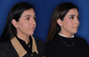 37 year old female patient 10 months post-op from a Rhinoplasty.