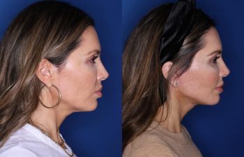 45 year old female patient 2 months post-op from a KalosLift (Mini Extended Deep Plane Facelift) with Platysmaplasty