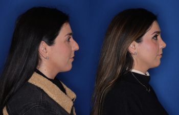 37 year old female patient 10 months post-op from a Rhinoplasty.